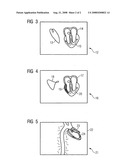 Method for determining cardiac impulse conduction and associated medical device diagram and image