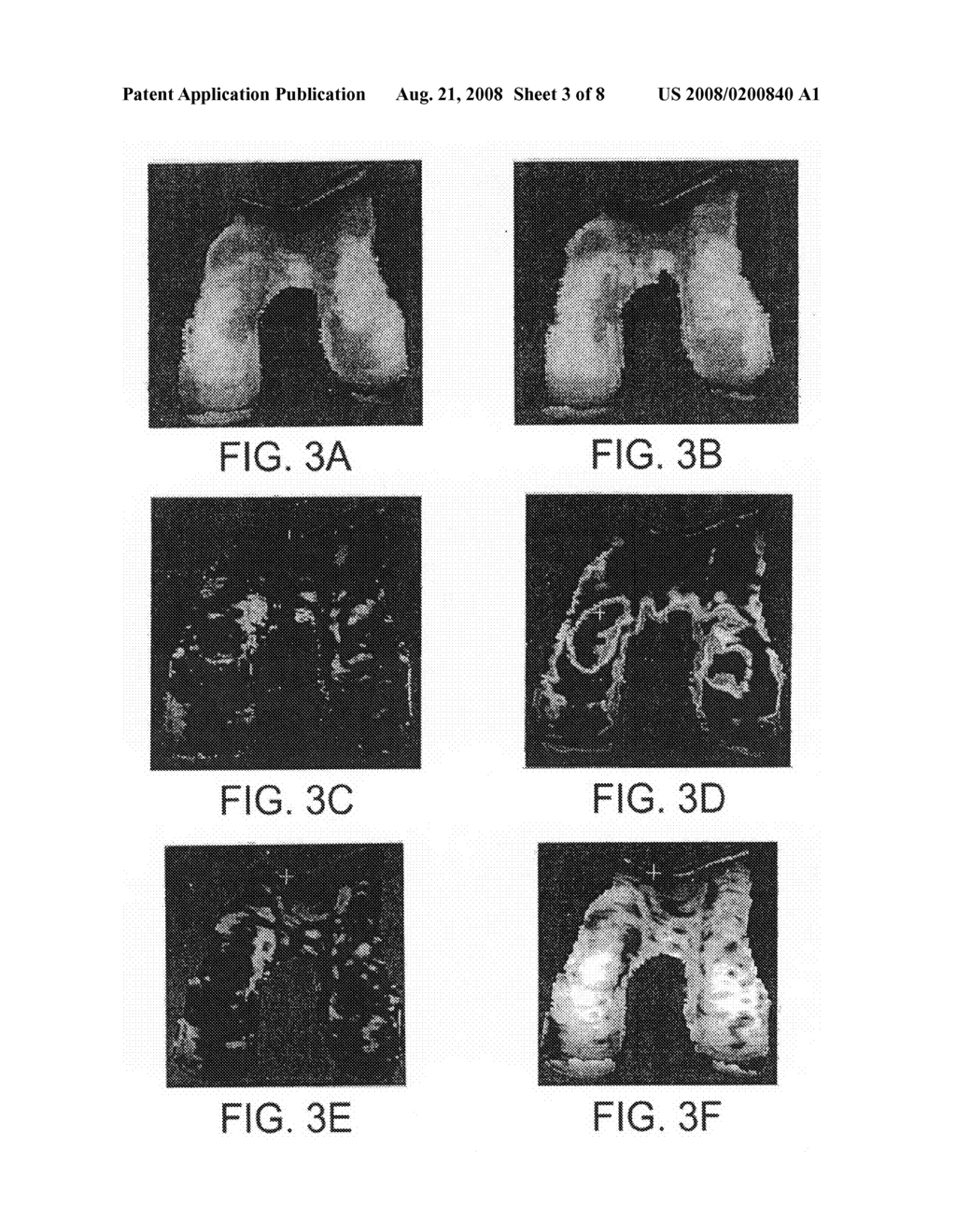 Structural quantification of cartilage changes using statistical parametric mapping - diagram, schematic, and image 04