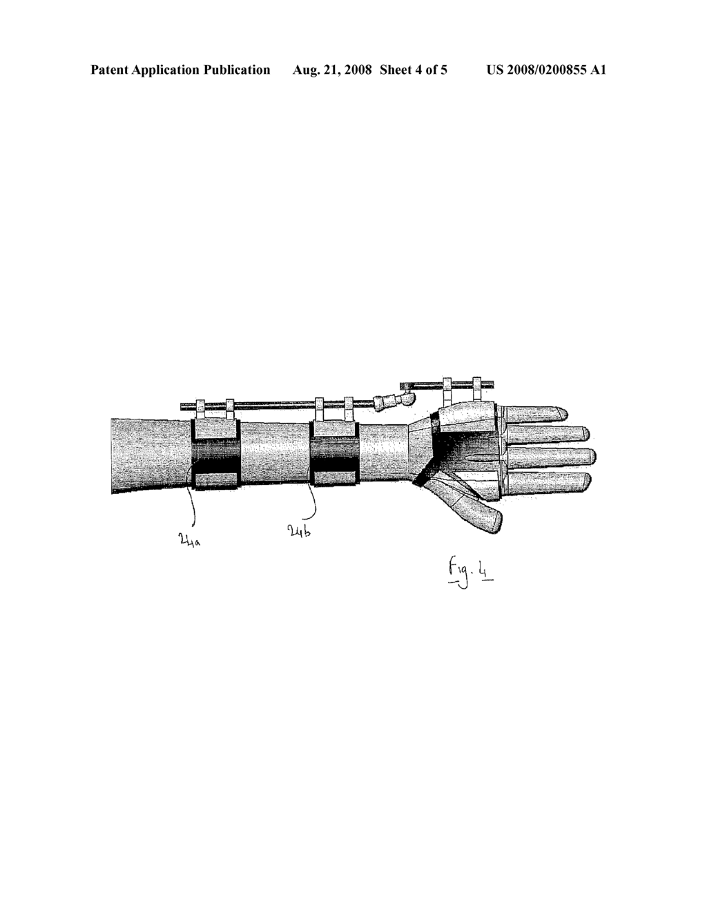 Fixator or Splint - diagram, schematic, and image 05