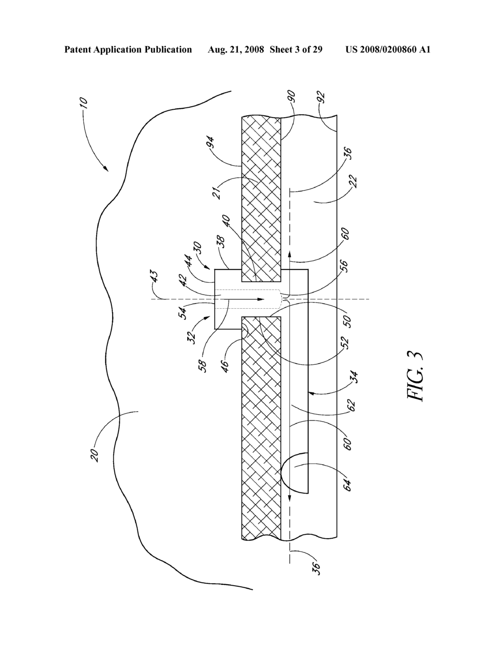 SYSTEM FOR TREATING OCULAR DISORDERS AND METHODS THEREOF - diagram, schematic, and image 04