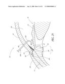 SYSTEM FOR TREATING OCULAR DISORDERS AND METHODS THEREOF diagram and image