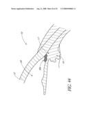 SYSTEM FOR TREATING OCULAR DISORDERS AND METHODS THEREOF diagram and image