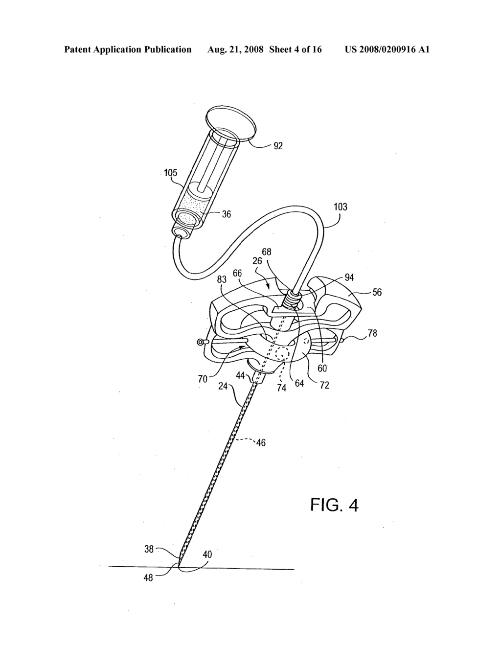 Cement Delivery Needle - diagram, schematic, and image 05