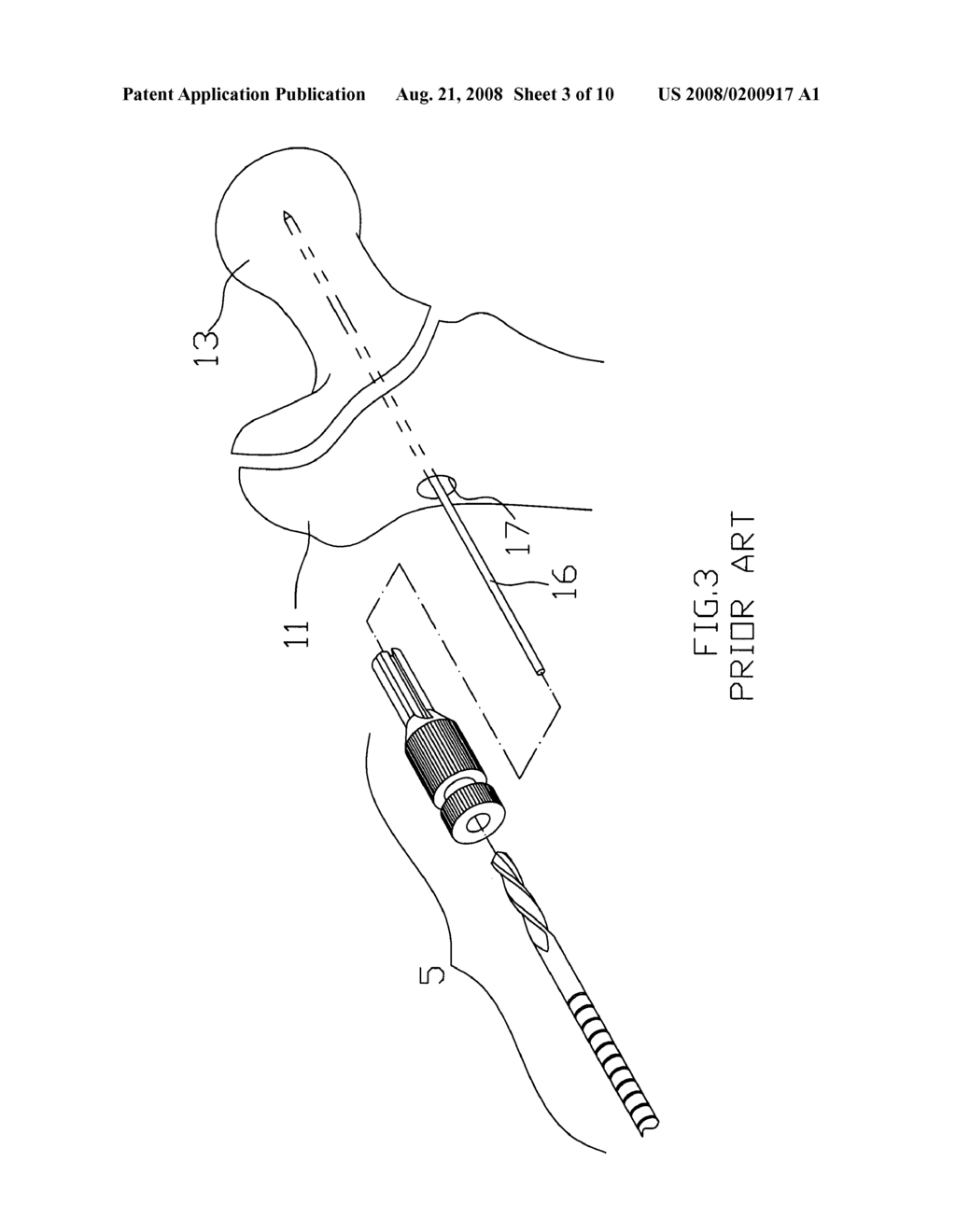 Targeting device for femur intertrochanteric fracture - diagram, schematic, and image 04