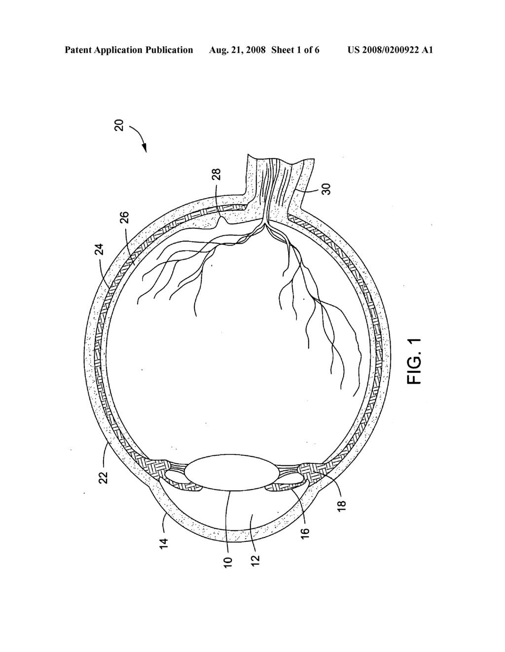 Apparatus for inserting flexible medical implant - diagram, schematic, and image 02