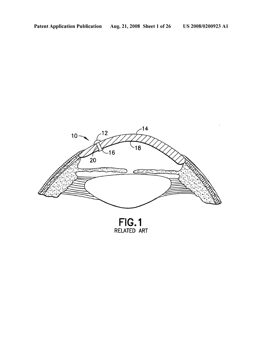 Insertion tool for ocular implant and method for using same - diagram, schematic, and image 02