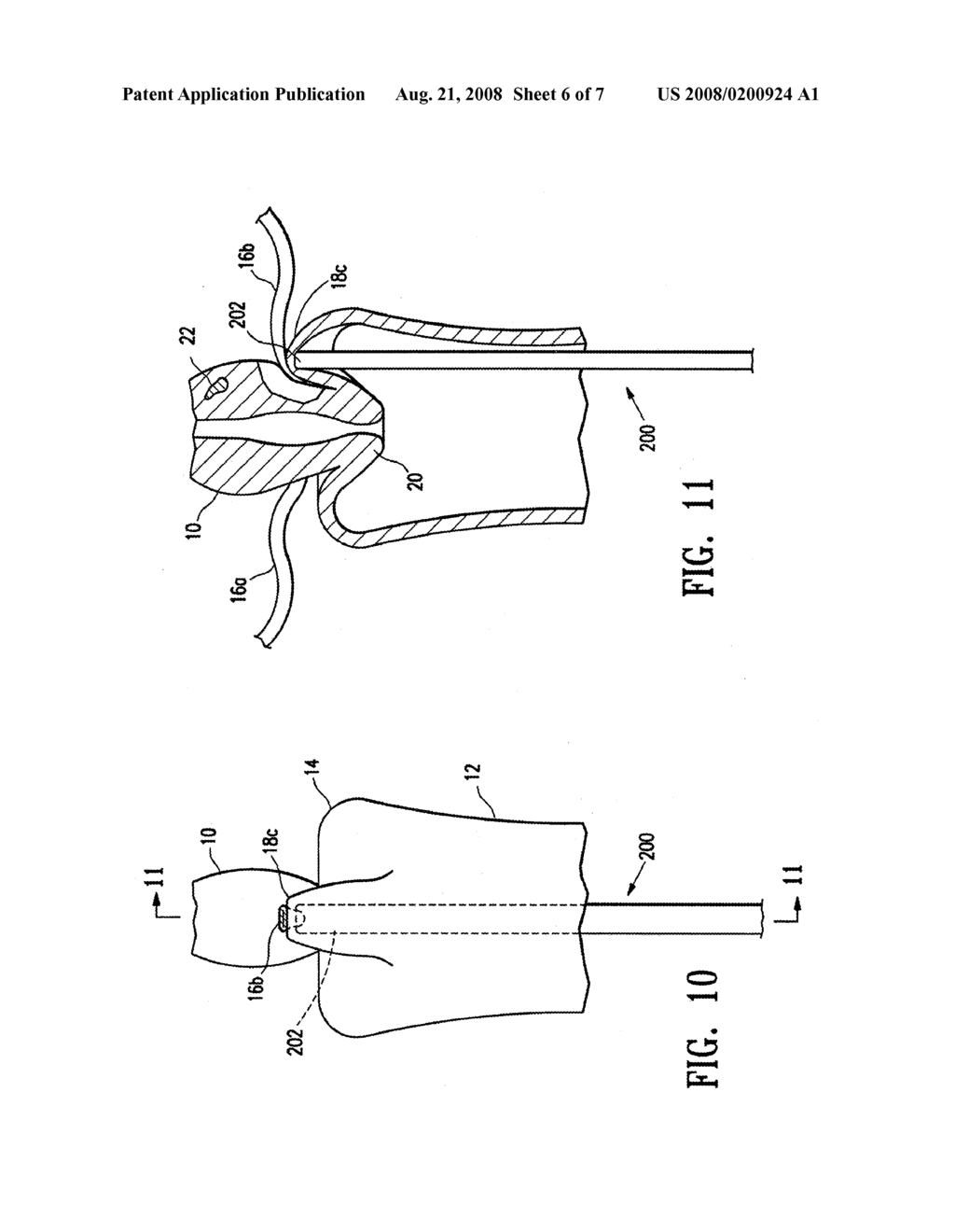 METHODS FOR MINIMALLY INVASIVE, NON-PERMANENT OCCLUSION OF A UTERINE ARTERY - diagram, schematic, and image 07