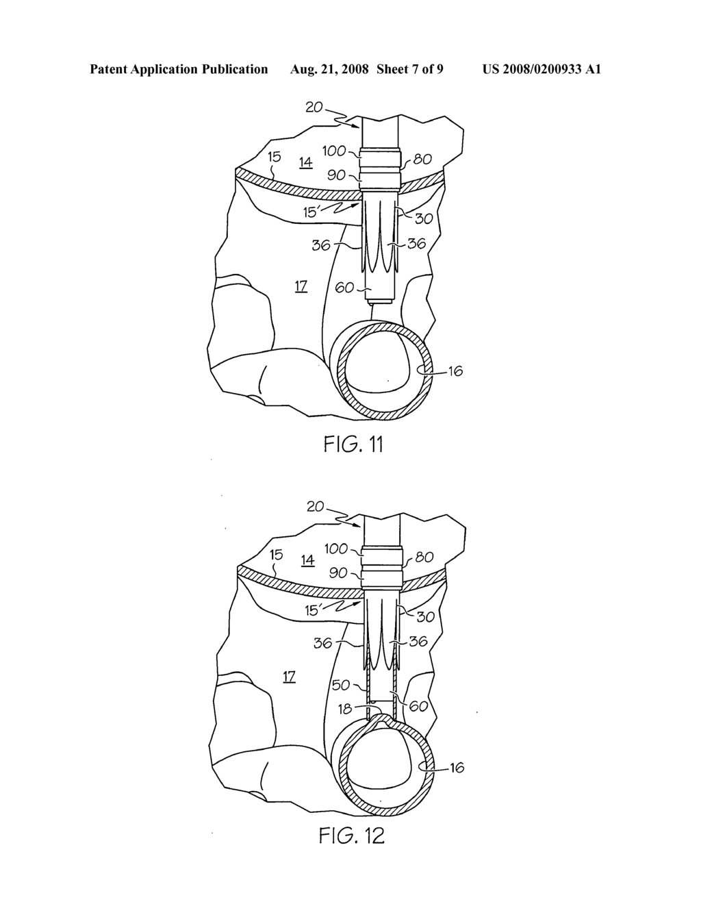 Surgical devices and methods for forming an anastomosis between organs by gaining access thereto through a natural orifice in the body - diagram, schematic, and image 08