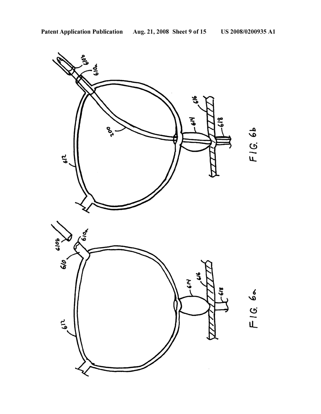 Anastomosis Device and Method - diagram, schematic, and image 10