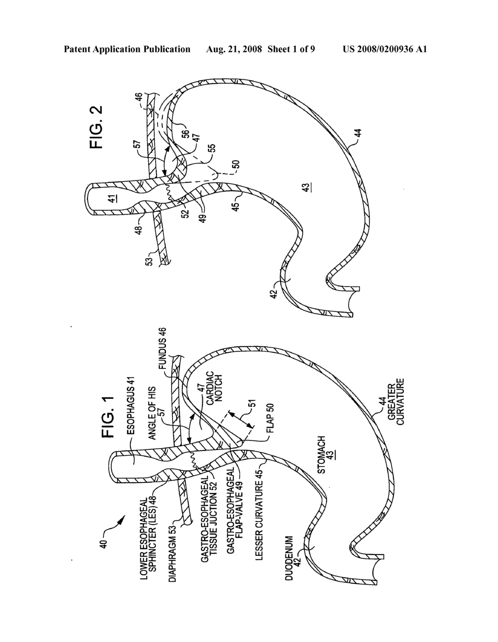Transoral endoscopic gastroesophageal flap valve restoration device, assembly, system and method - diagram, schematic, and image 02