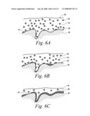 Bio-absorbable oil suspension diagram and image