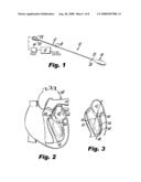 Heart assist device diagram and image