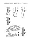 Heart assist device diagram and image