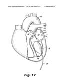 Heart assist device diagram and image