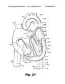 Heart assist device diagram and image