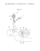 Endoscopic treatment instrument diagram and image