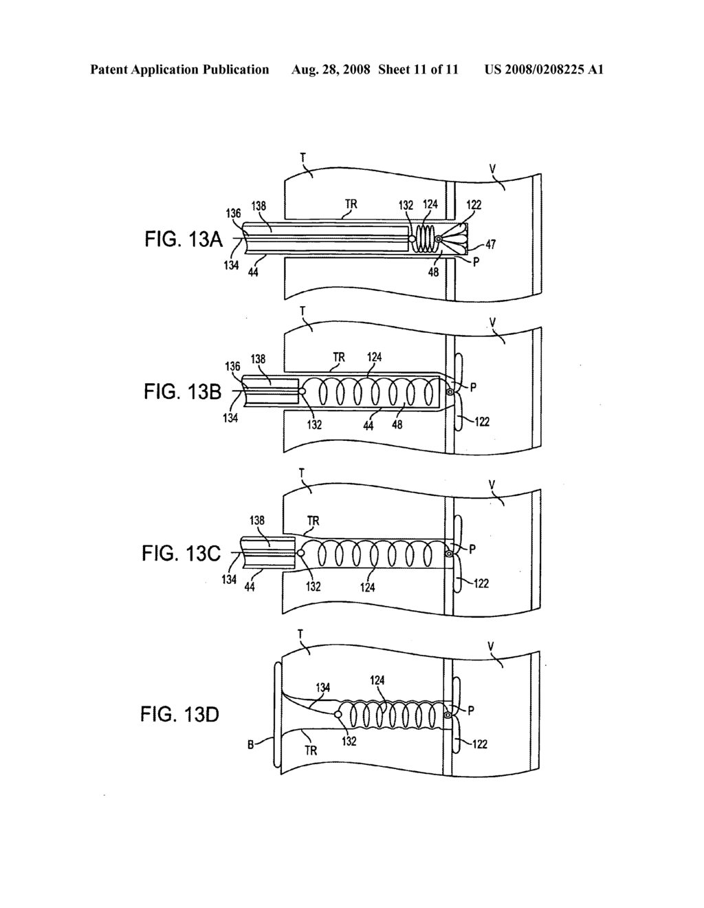 APPARATUS FOR SEALING SURGICAL PUNCTURES - diagram, schematic, and image 12