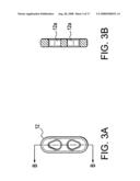 BUNION REPAIR USING SUTURE-BUTTON CONSTRUCT diagram and image