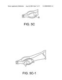 BUNION REPAIR USING SUTURE-BUTTON CONSTRUCT diagram and image