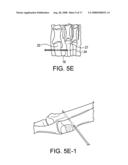 BUNION REPAIR USING SUTURE-BUTTON CONSTRUCT diagram and image