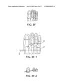 BUNION REPAIR USING SUTURE-BUTTON CONSTRUCT diagram and image