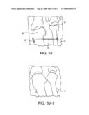 BUNION REPAIR USING SUTURE-BUTTON CONSTRUCT diagram and image