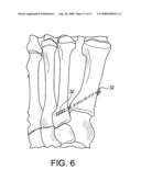 BUNION REPAIR USING SUTURE-BUTTON CONSTRUCT diagram and image