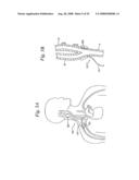 BAROREFLEX ACTIVATION FOR PAIN CONTROL, SEDATION AND SLEEP diagram and image