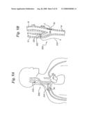 BAROREFLEX ACTIVATION FOR PAIN CONTROL, SEDATION AND SLEEP diagram and image