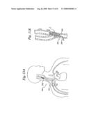 BAROREFLEX ACTIVATION FOR PAIN CONTROL, SEDATION AND SLEEP diagram and image