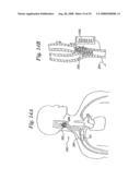 BAROREFLEX ACTIVATION FOR PAIN CONTROL, SEDATION AND SLEEP diagram and image