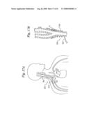 BAROREFLEX ACTIVATION FOR PAIN CONTROL, SEDATION AND SLEEP diagram and image