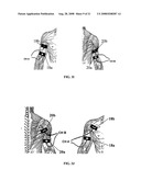 Electrical stimulation device and method for the treatment of neurological disorders diagram and image