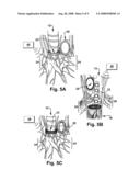 APPARATUS AND METHODS FOR TREATING PULMONARY CONDITIONS diagram and image