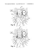 APPARATUS AND METHODS FOR TREATING PULMONARY CONDITIONS diagram and image