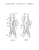 Apparatus and method for implantation of a bifurcated endovascular prosthesis diagram and image