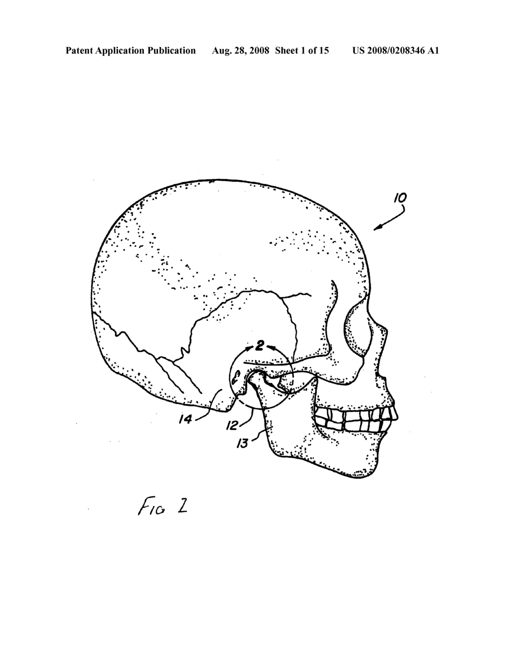 Prosthesis for interpositional location between bone joint articular surfaces and method of use - diagram, schematic, and image 02