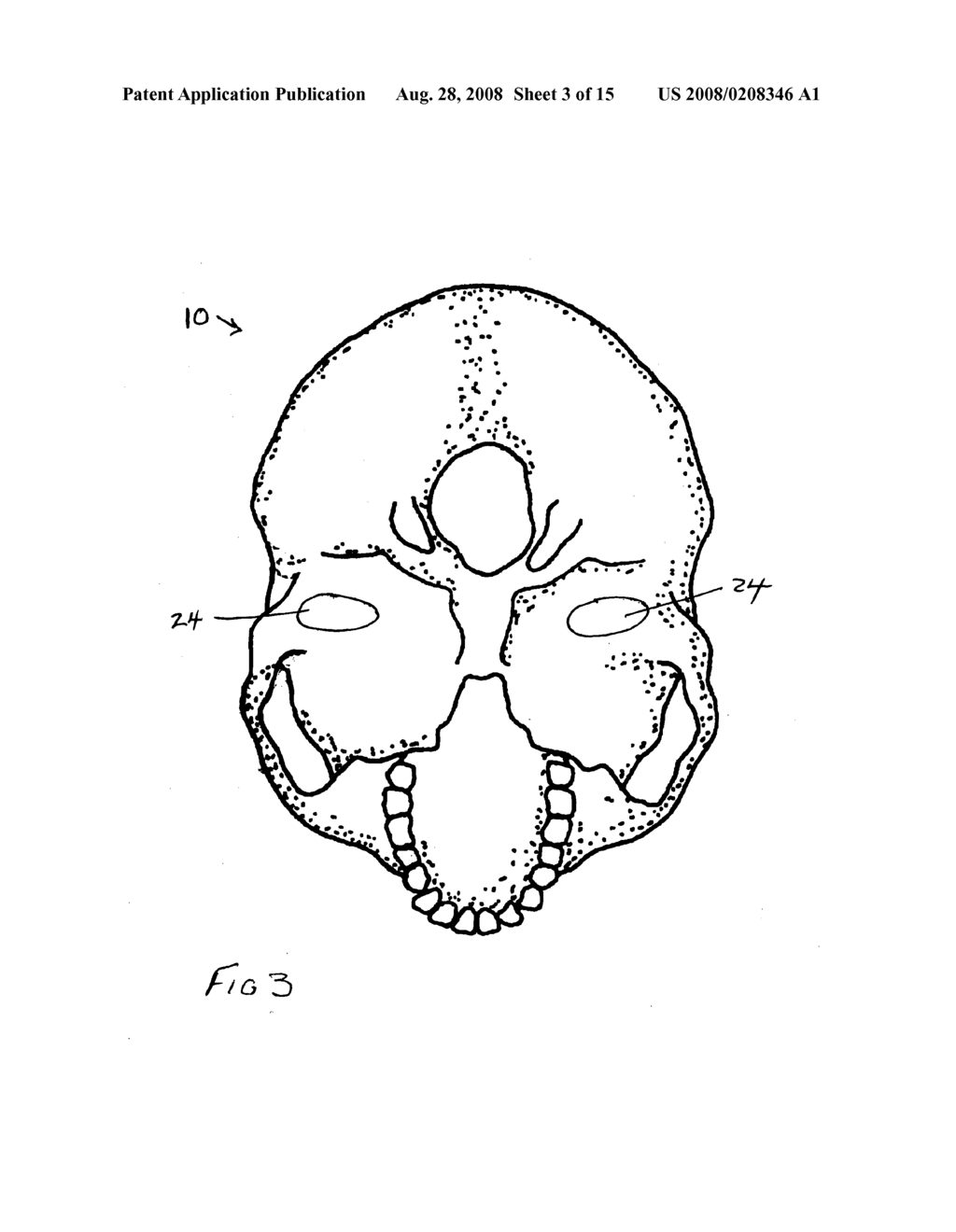 Prosthesis for interpositional location between bone joint articular surfaces and method of use - diagram, schematic, and image 04