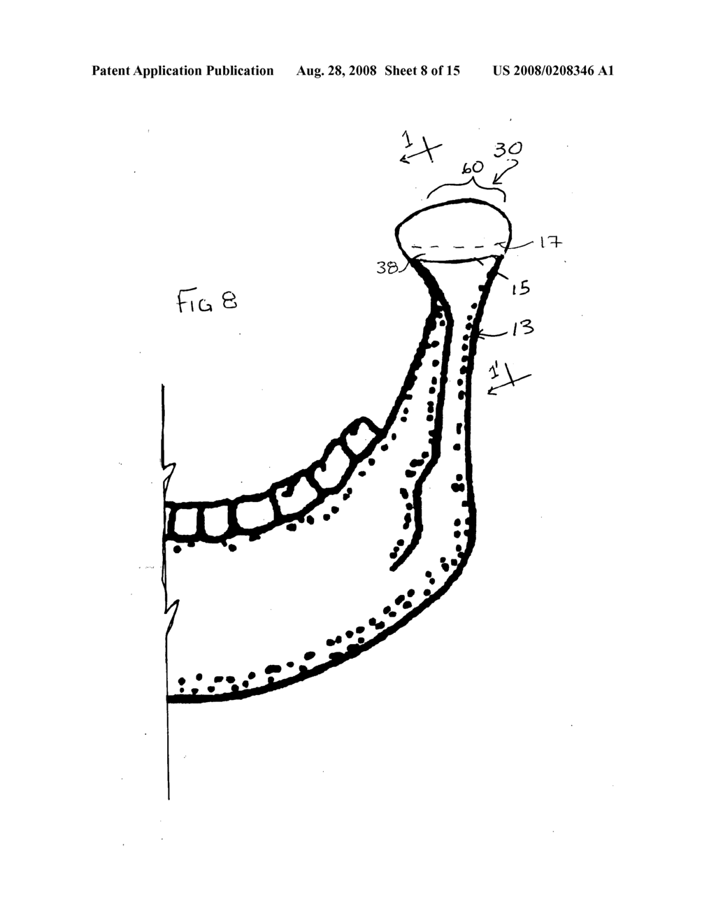 Prosthesis for interpositional location between bone joint articular surfaces and method of use - diagram, schematic, and image 09