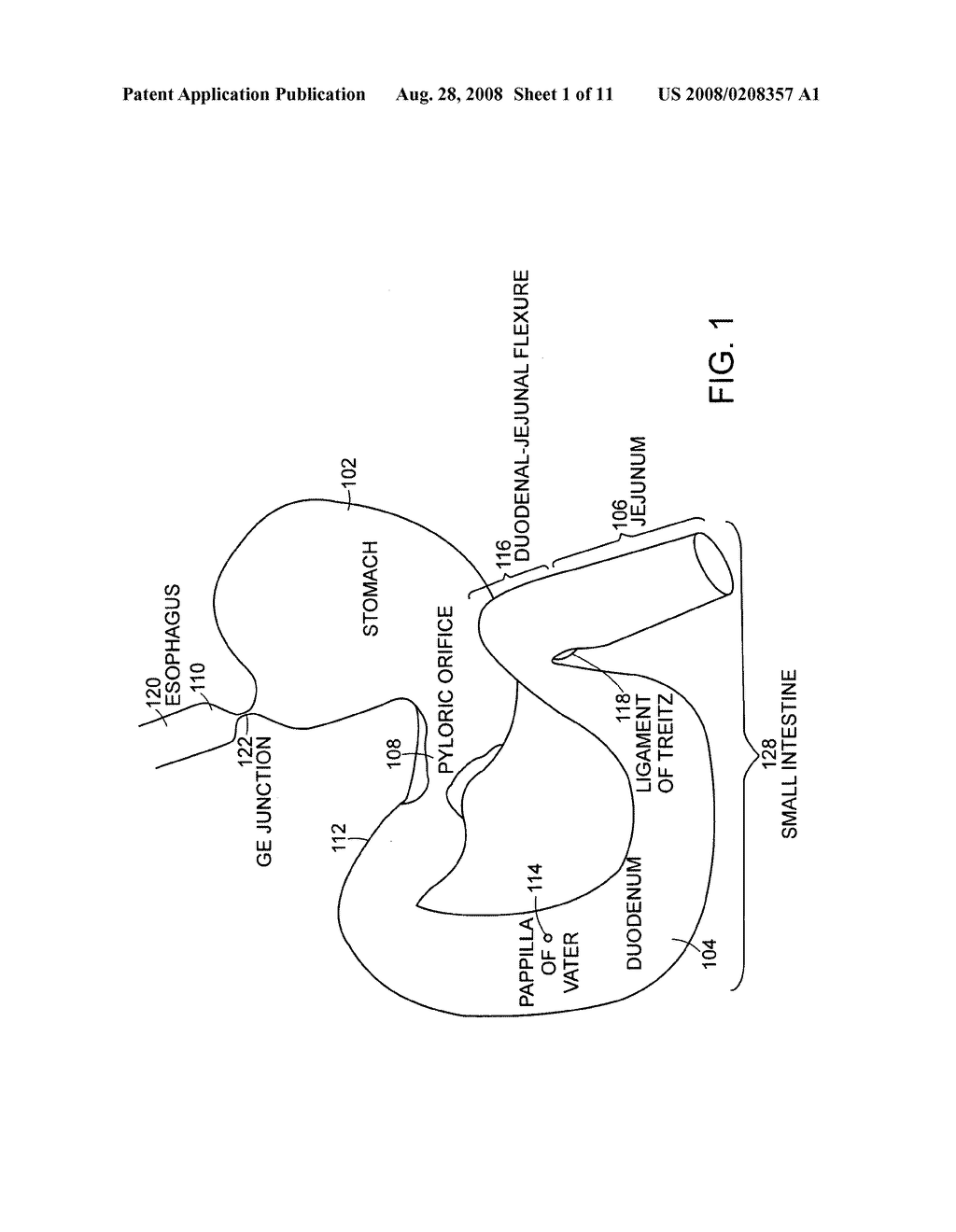 Use of a gastrointestinal sleeve to treat bariatric surgery fistulas and leaks - diagram, schematic, and image 02