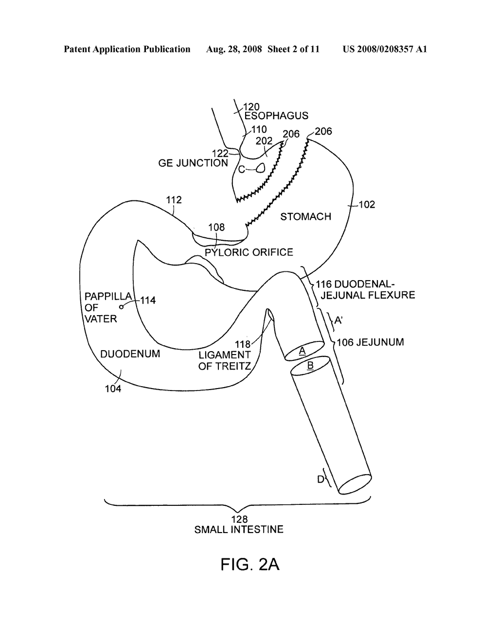 Use of a gastrointestinal sleeve to treat bariatric surgery fistulas and leaks - diagram, schematic, and image 03