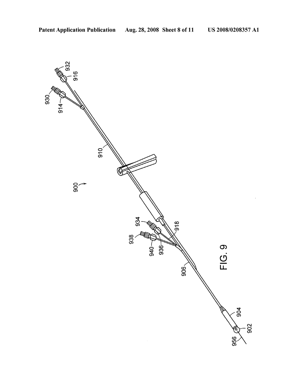 Use of a gastrointestinal sleeve to treat bariatric surgery fistulas and leaks - diagram, schematic, and image 09