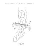 DEVICES AND METHODS OF APPLYING DENTAL COMPOSITES diagram and image