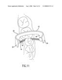 DEVICES AND METHODS OF APPLYING DENTAL COMPOSITES diagram and image