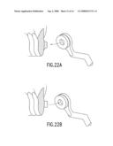 DEVICES AND METHODS OF APPLYING DENTAL COMPOSITES diagram and image