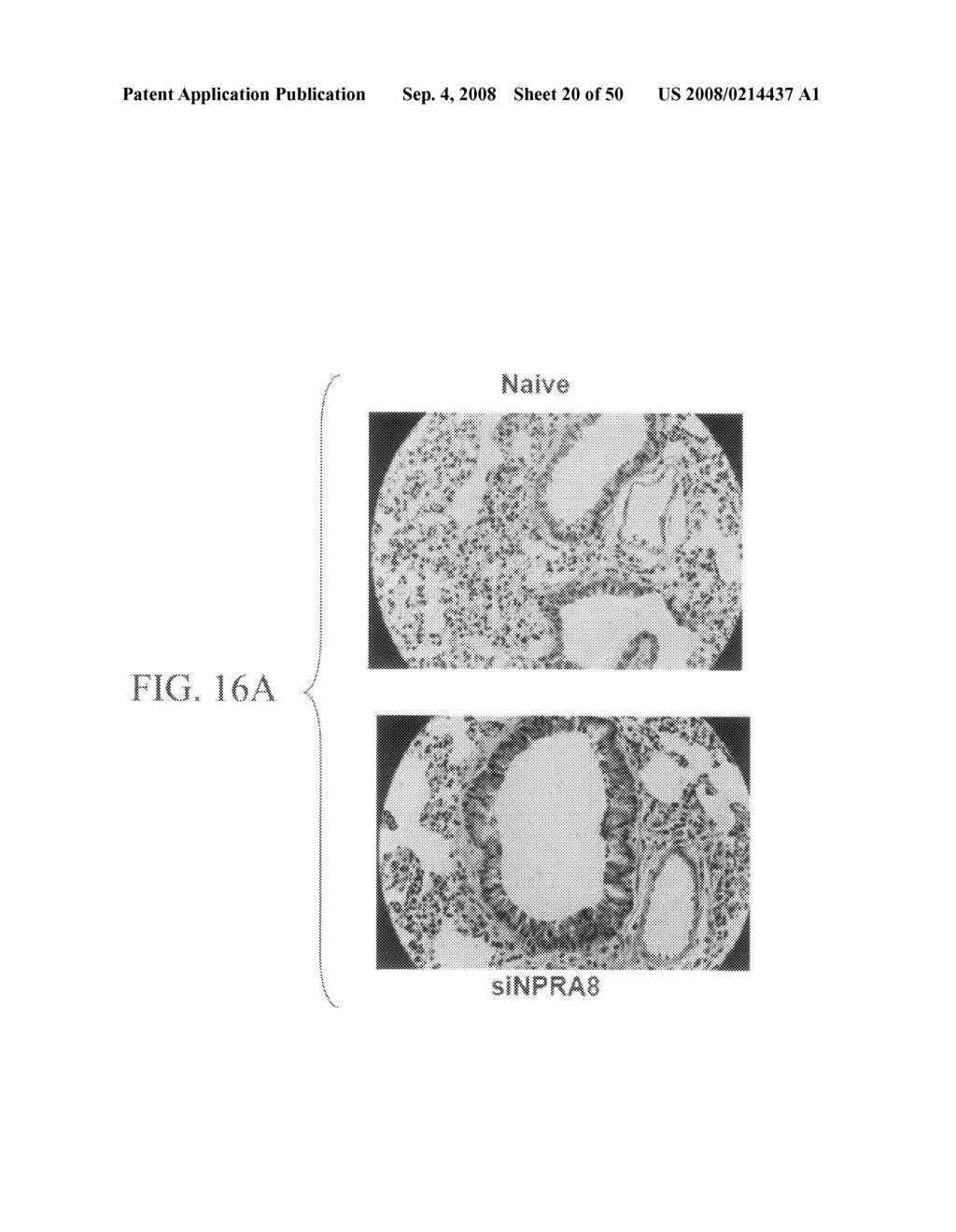 Methods and compositions for reducing activity of the atrial natriuretic peptide receptor and for treatment of diseases - diagram, schematic, and image 21