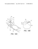 Therapeutic method and therapeutic system used with steps for approaching to lesion using overtube diagram and image