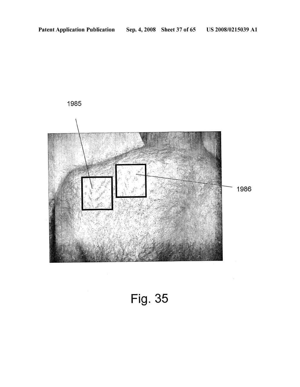 Method and Apparatus for Inhibiting Pain Signals During Vacuum-Assisted Medical Treatments of the Skin - diagram, schematic, and image 38