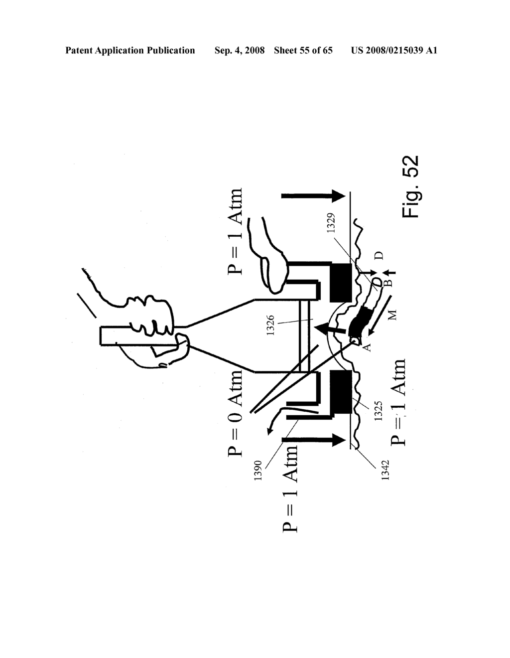 Method and Apparatus for Inhibiting Pain Signals During Vacuum-Assisted Medical Treatments of the Skin - diagram, schematic, and image 56