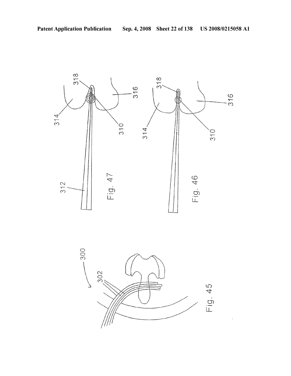 Spine distraction implant and method - diagram, schematic, and image 24